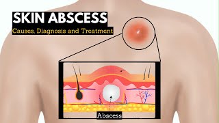 Skin Abscess Causes Signs and Symptoms Diagnosis and Treatment [upl. by Eibloc]