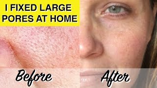 DIY LARGE PORES TREATMENT At Home Glycolic Acid Peel Dramatically Reduces Pores amp Wrinkles [upl. by Delfeena]