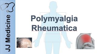 Polymyalgia Rheumatica  Signs amp Symptoms Diagnosis and Treatment [upl. by Lamoree]