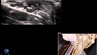 How To Ultrasound Guided Interscalene Nerve Block 3D Video [upl. by Duval]