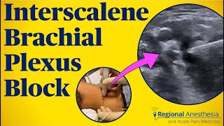 Interscalene Brachial Plexus Block [upl. by Pontone]