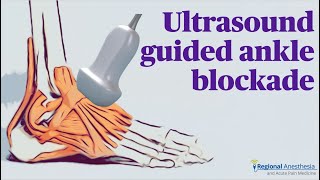 Ultrasound Guided Ankle Block [upl. by Georgeta69]