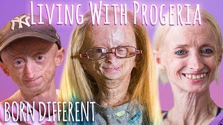 Progeria Accelerated Aging  Biochemical Mechanism of Progeria [upl. by Hedveh669]