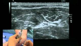 Ulnar nerve block ultrasound guided [upl. by Martijn]