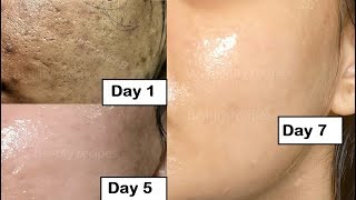 Skin Repair  Close Large OPEN PORES in 1 week Remove Dark Spots Anti Aging [upl. by Rozele]