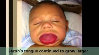 Evan six months infantile spasms  West Syndrome [upl. by Gelhar]