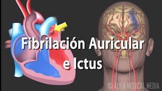 Fibrilación Auricular e Ictus Animación Alila Medical Media Español [upl. by Amliw8]