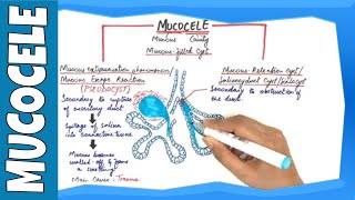 Mucocele  Types Clinical Features Histopathalogic features amp Treatment [upl. by Auof]