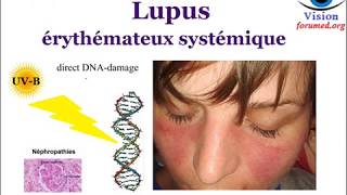 Lupus érythémateux Systémique Signes cliniques Biologiques physiopathologie [upl. by Aicined614]