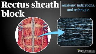 Rectus Sheath Block [upl. by Coad]