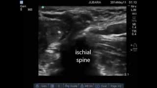 ultrasound guided pudendal nerve block [upl. by Malamut]