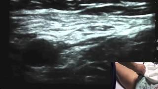 Ultrasound Guided Femoral Nerve Block  SSRAUSAcom [upl. by Arahat]