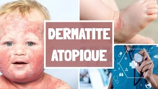 LA DERMATITE ATOPIQUE CAUSES  SYPMTOMES  COMPLICATIONS  TRAITEMENT [upl. by Lucian]