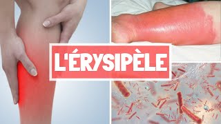 ÉRYSIPÈLE  CAUSES  SYPMTOMES  COMPLICATIONS  TRAITEMENT [upl. by Azmuh]