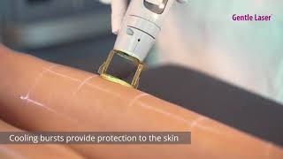 Laser Hair Removal  Candela GentleMax Pro [upl. by Rizika]