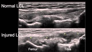 Sonographic Examination of Knee Ligaments [upl. by Halla763]