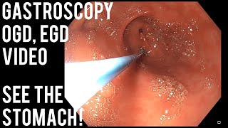 Gastroscopy  OGD  See inside the stomach [upl. by Aicekat]