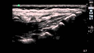 Ultrasound Guided Pediatric Caudal Block  SSRAUSAcom [upl. by Malvin]