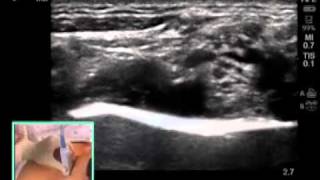 ULTRASOUNDGUIDED SUPRACLAVICULAR NERVE BLOCK [upl. by Alaunnoif4]