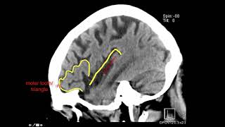 Introduction to Brain Surface Anatomy [upl. by Ailisec]