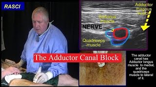 The Adductor canal block [upl. by Janus]