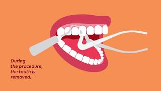 What to Know for Your Tooth Extraction  Colgate® [upl. by Armmat]