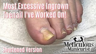 Most Extreme Ingrown Toenail Salon Pedicure  Shortened [upl. by Maxia]