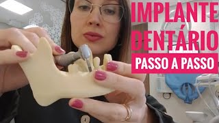 Implante Dentário Passo a Passo l Dra Danielle Sales [upl. by Atinit]