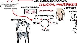 Dermatomyositis Overview [upl. by Holds]