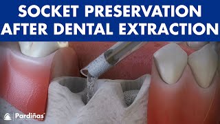 Tooth extraction  Treatment for socket preservation © [upl. by Esinyt315]