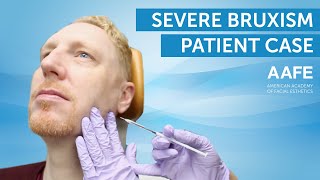 Treating Bruxism with Botox  AAFE [upl. by Bayer]