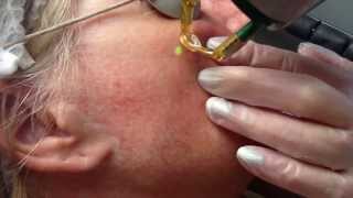 Laser treatment for facial thread veins with Candela NdYag laser [upl. by Hsirk]