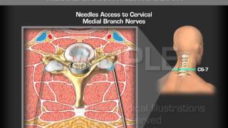 Anterior Cervical Discectomy amp Fusion at C45 amp C56 [upl. by Natsirhc]