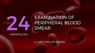 Anemia Lesson 4  Clues from the blood smear [upl. by Atews]