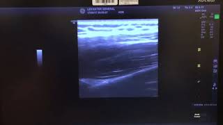 Suprascapular Nerve Block Ultrasound Guided [upl. by Pollitt]