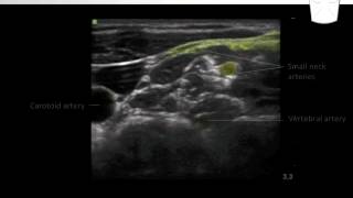 Cervical Plexus Block  Nerve Localization [upl. by Kroy537]