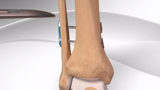 High Ankle Sprain [upl. by Anibas8]