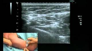 Radial Nerve Block ultrsound guided [upl. by Bevan396]