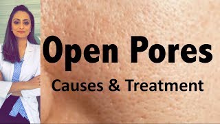 Open Pores Causes amp Treatment  Dermatologists opinion  Dr Aanchal Panth [upl. by Netram]