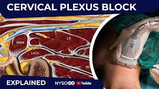 Cervical Plexus Block  Regional anesthesia Crash course with Dr Hadzic [upl. by Daveen]