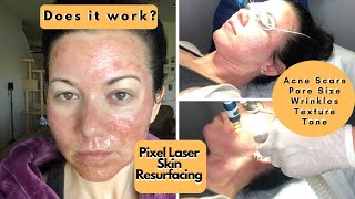 Pixel Laser Treatment For Acne Scars amp Big Pores [upl. by Enelyak668]