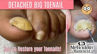 How To Pedicure Transformation for Men on Detached Toenails [upl. by Eenram670]