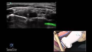 Ultrasound guided Saphenous Nerve Block [upl. by Eat267]