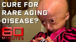 Progeria Syndrome Explained  How it is caused [upl. by Olwen]