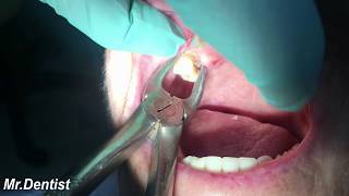 RealLife Tooth Extractions by Dentists [upl. by Edna146]